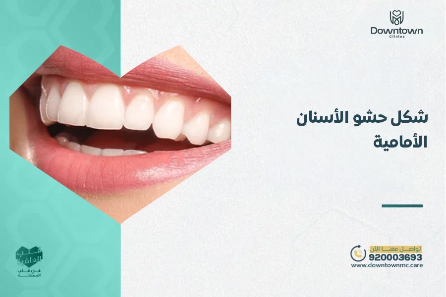 شكل حشو الأسنان الأمامية