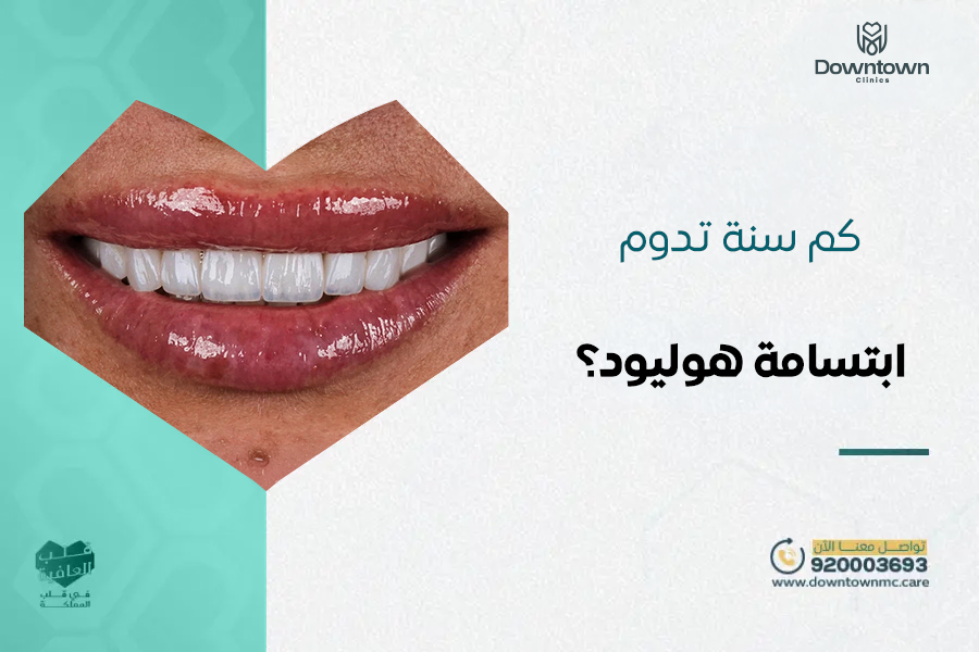 كم سنة تدوم ابتسامة هوليود