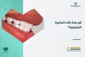 كم مدة بقاء الحشوة التجميلية