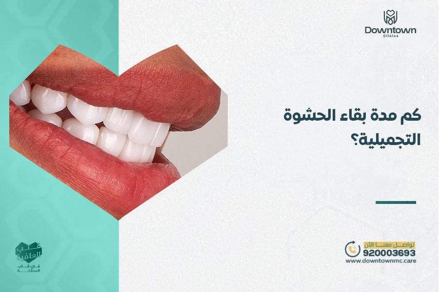 كم مدة بقاء الحشوة التجميلية