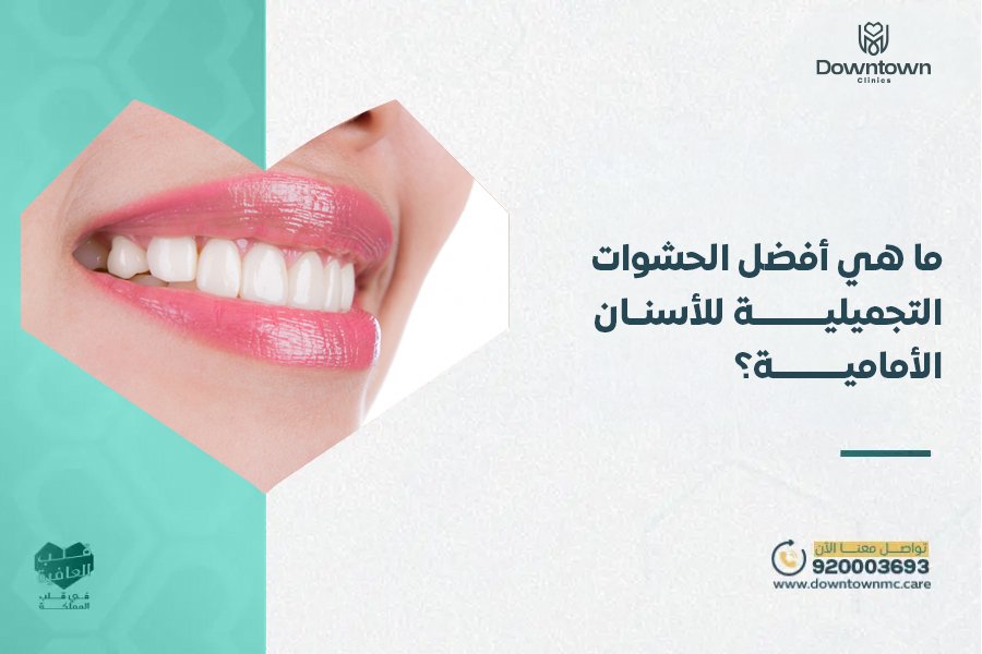 أفضل الحشوات التجميلية للأسنان الأمامية