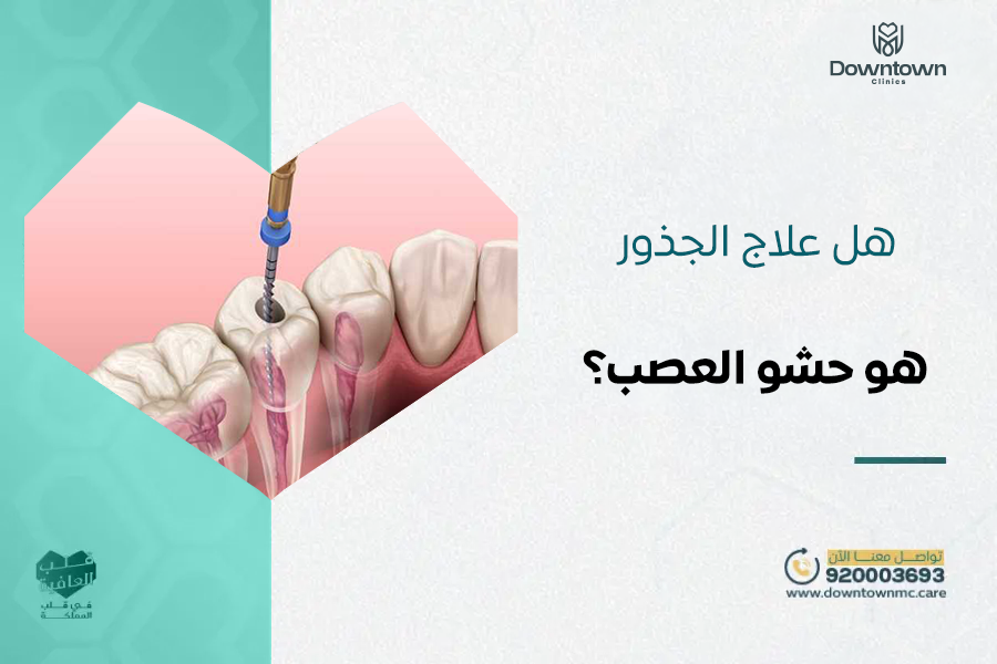 هل علاج الجذور هو حشو العصب
