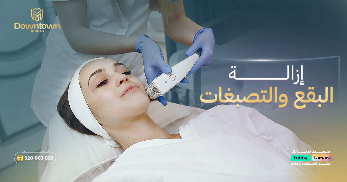 إزالة البقع والتصبغات بالليزر في السعودية