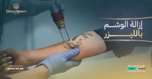 إزالة الوشم بالليزر في السعودية