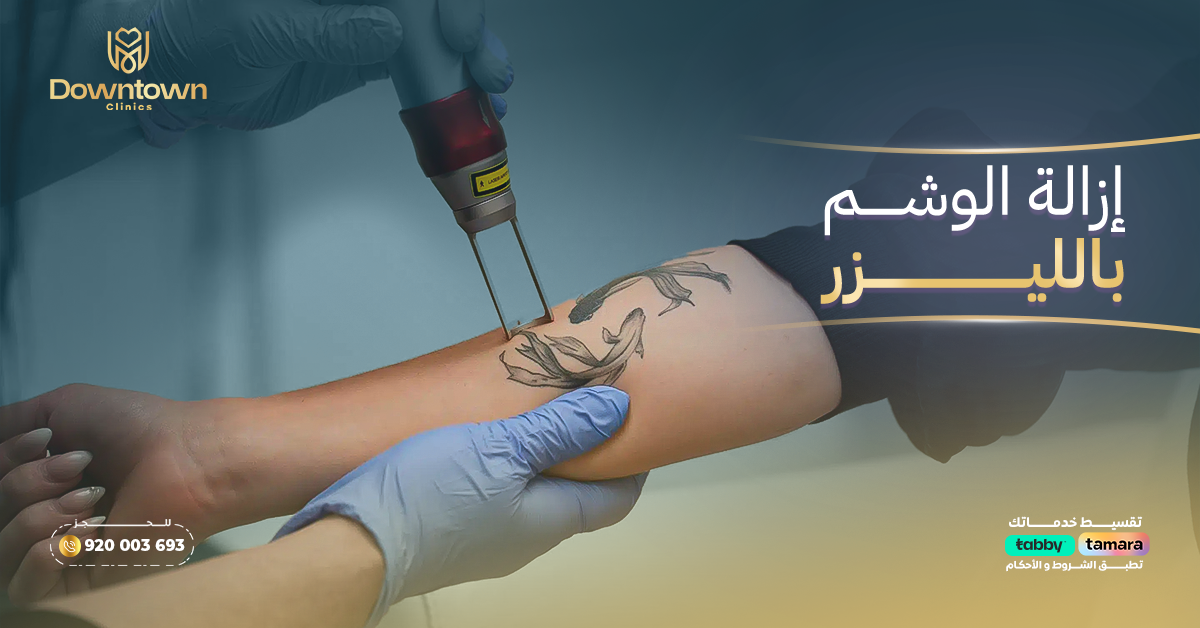 إزالة الوشم بالليزر في السعودية
