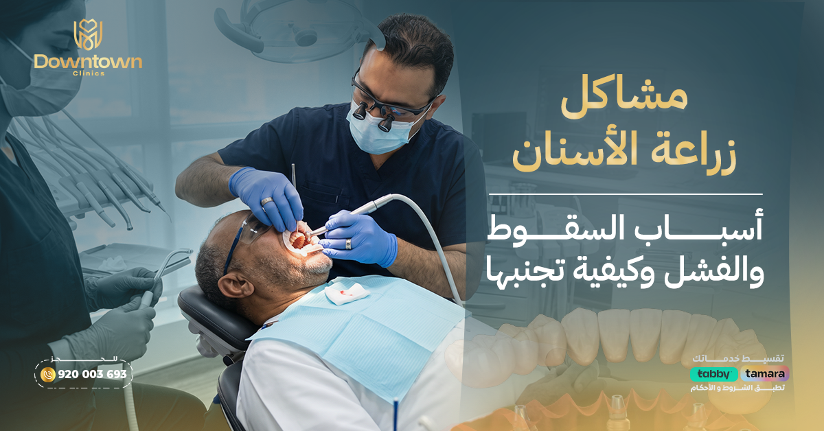 مشاكل زراعة الأسنان: أسباب السقوط والفشل وكيفية تجنبها