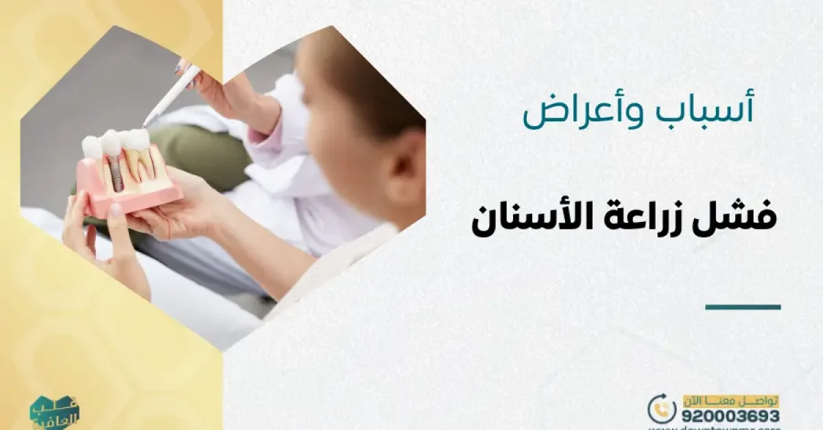 أبرز 5 أسباب وأعراض فشل زراعة الأسنان وكيفية تجنبها