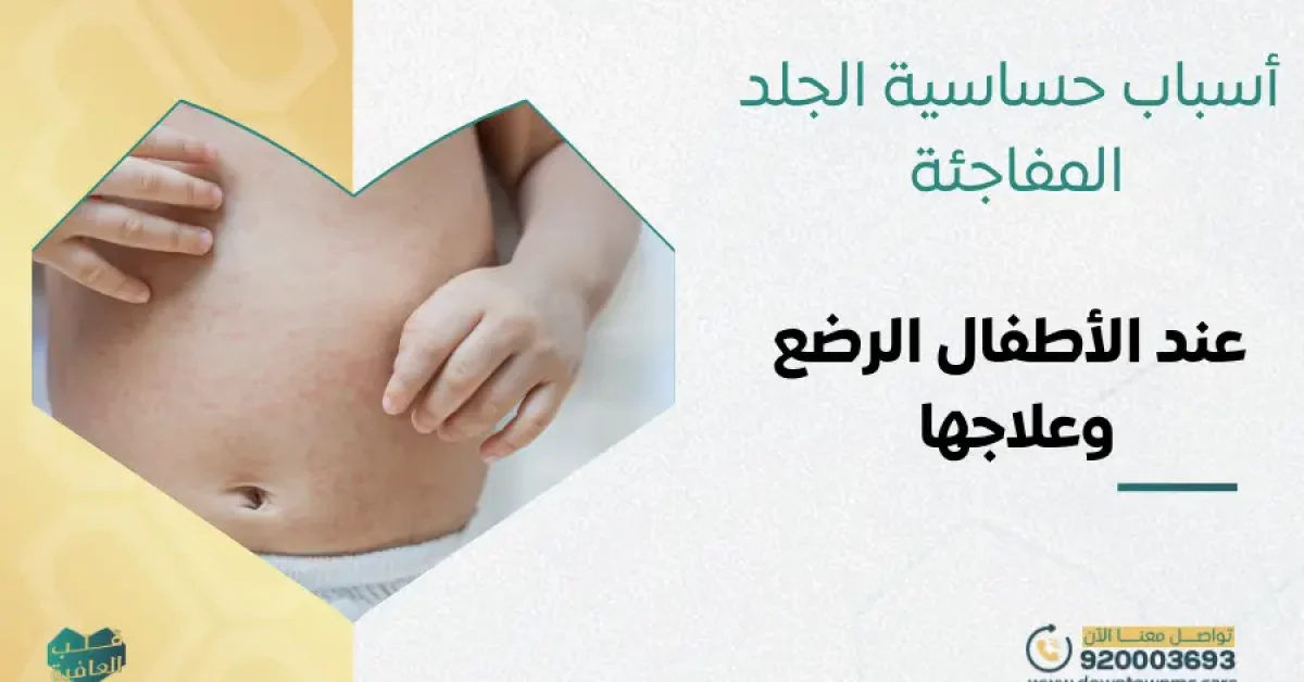 أسباب حساسية الجلد المفاجئة عند الأطفال الرضع وعلاجها​
