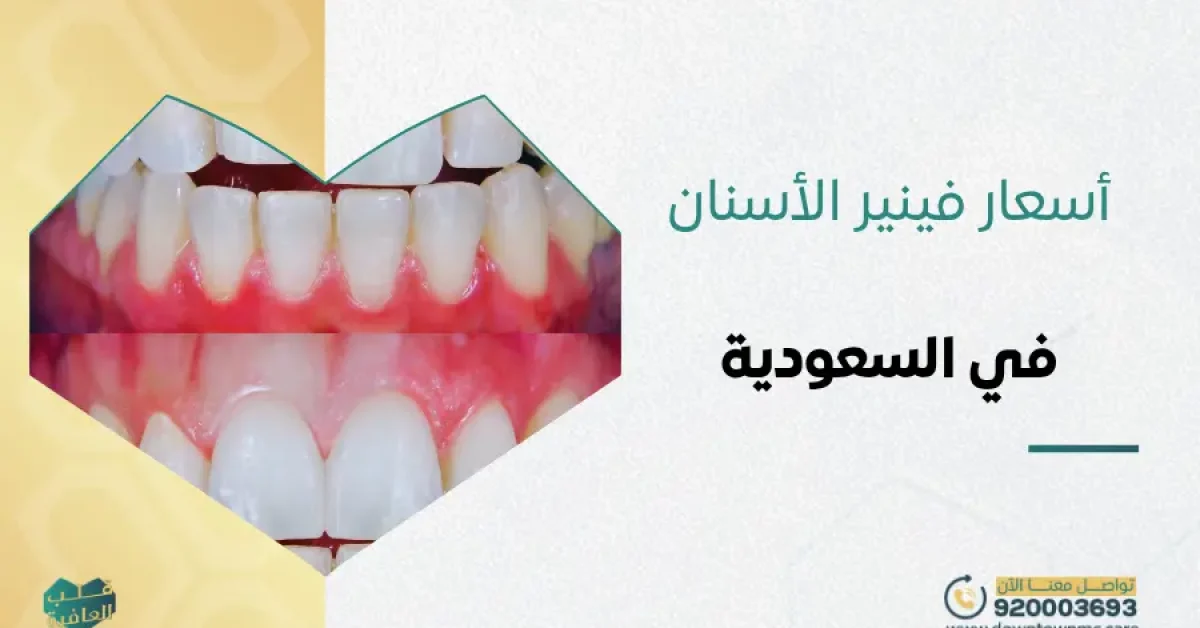 أسعار فينير الأسنان في السعودية