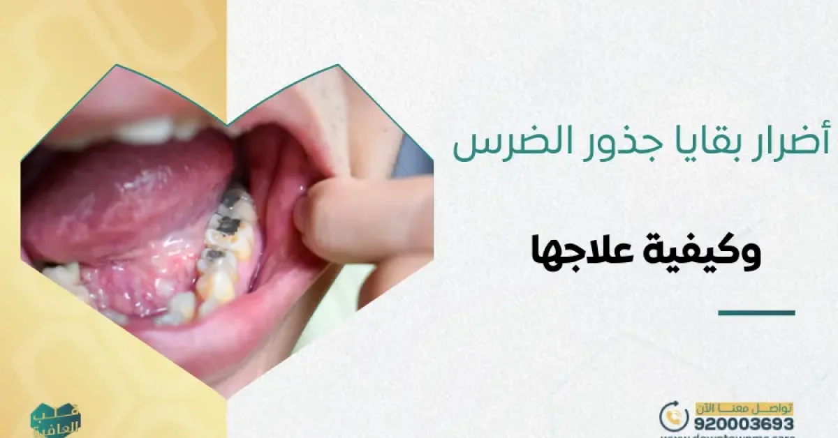 أضرار بقايا جذور الضرس وكيفية علاجها
