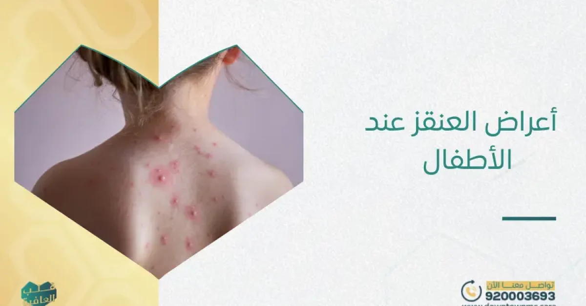أعراض العنقز عند الأطفال​
