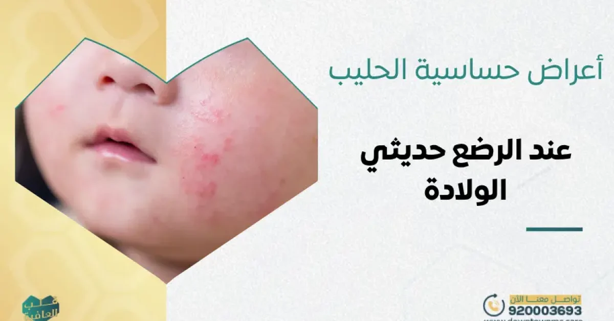 أعراض حساسية الحليب عند الرضع حديثي الولادة والعلاج