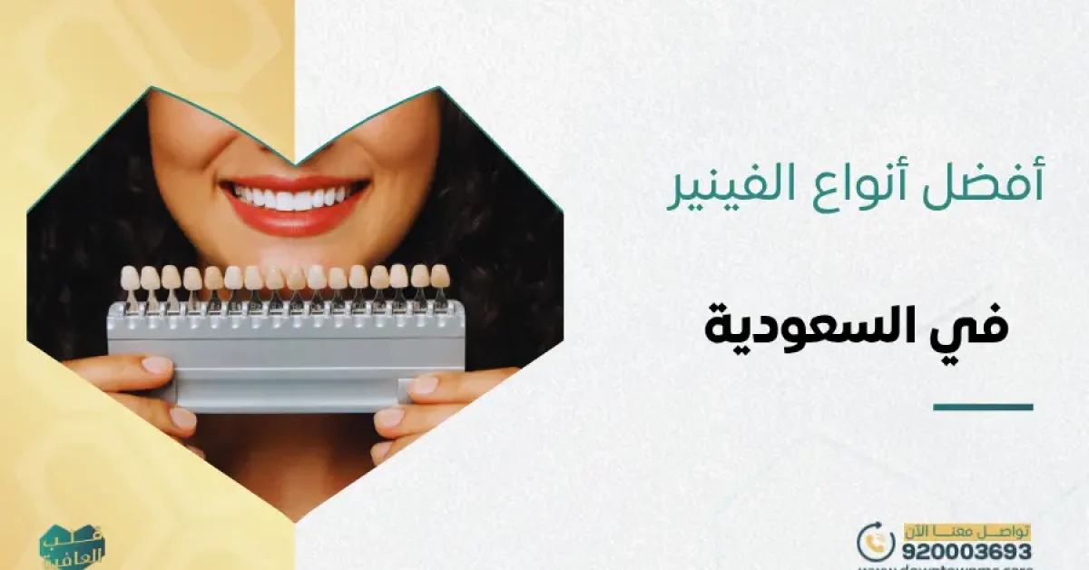 أفضل أنواع الفينير