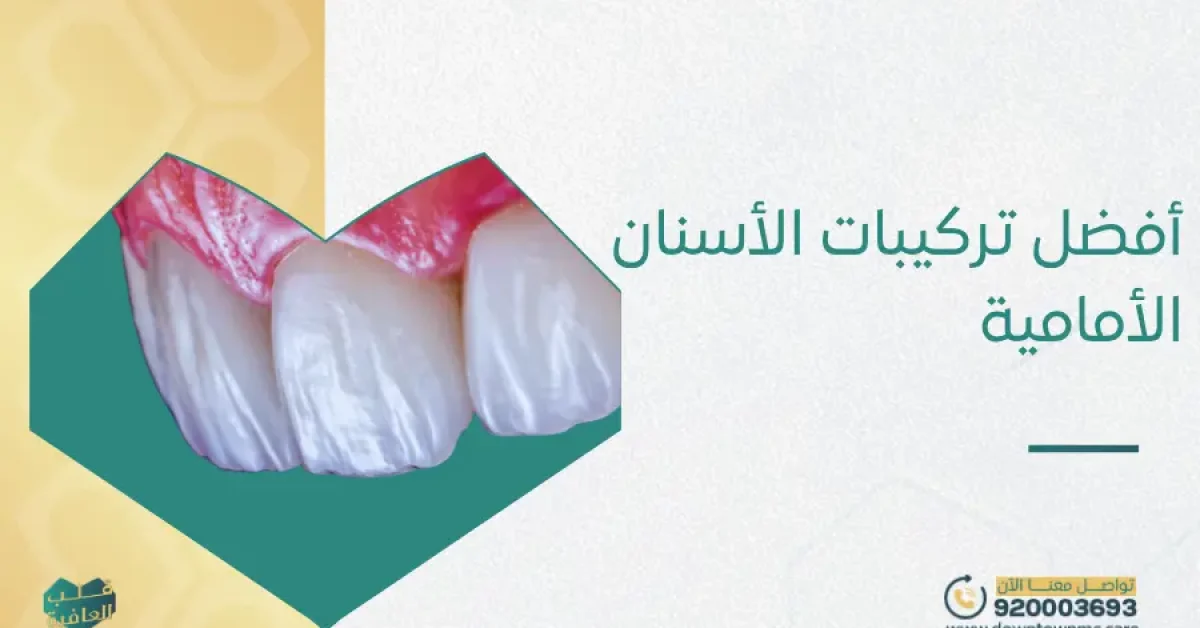 أفضل تركيبات الأسنان الأمامية جدة