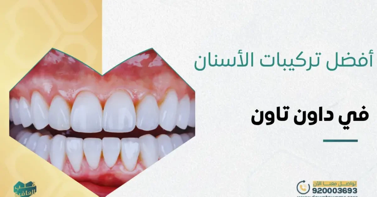 أفضل تركيبات الأسنان في داون تاون