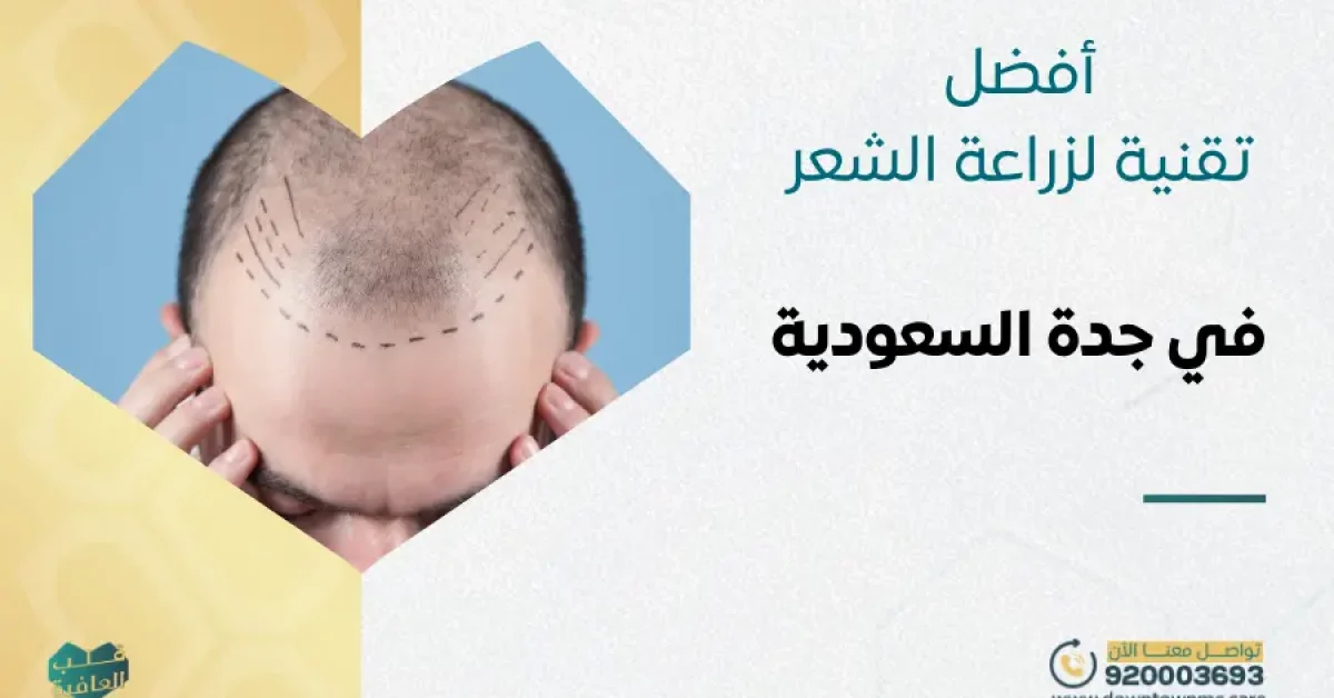 أفضل تقنية لزراعة الشعر في جدة السعودية