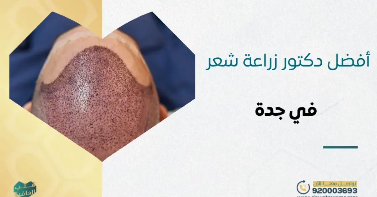 أفضل دكتور زراعة شعر في جدة