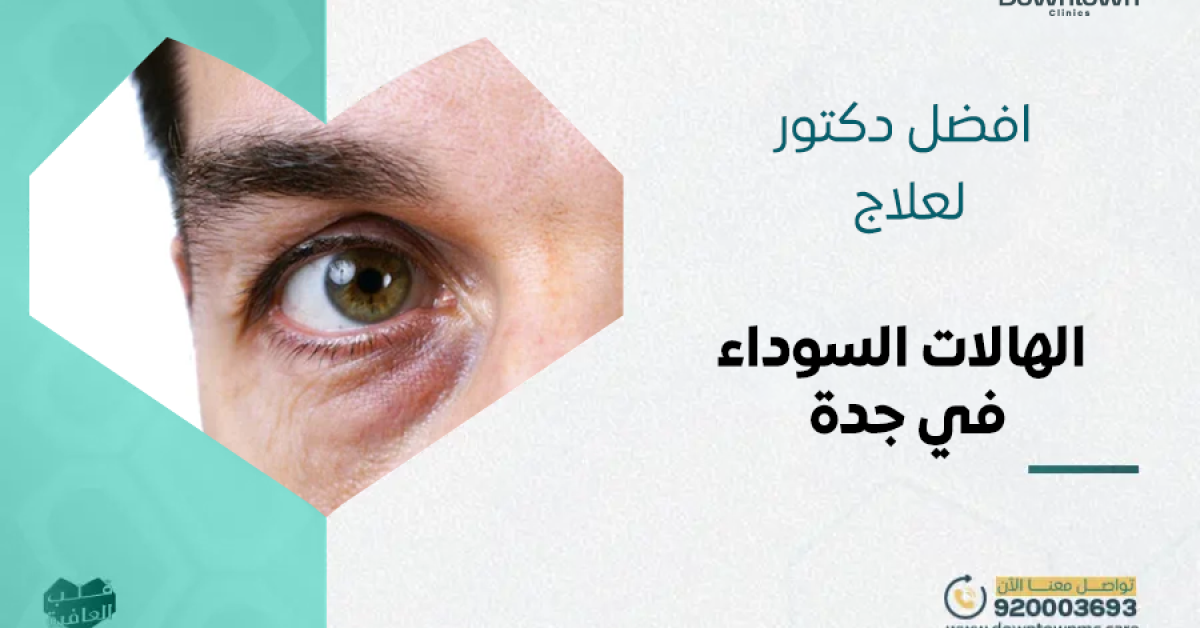 أفضل دكتور لعلاج الهالات السوداء في جدة