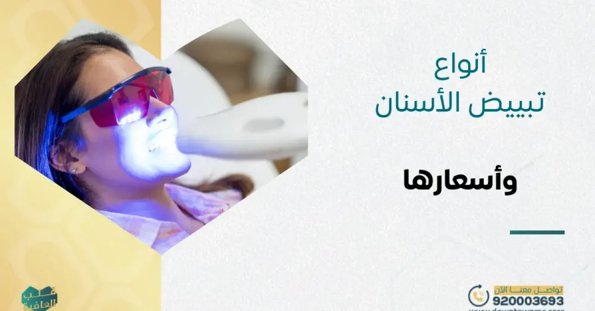 أنواع تبييض الأسنان وأسعارها