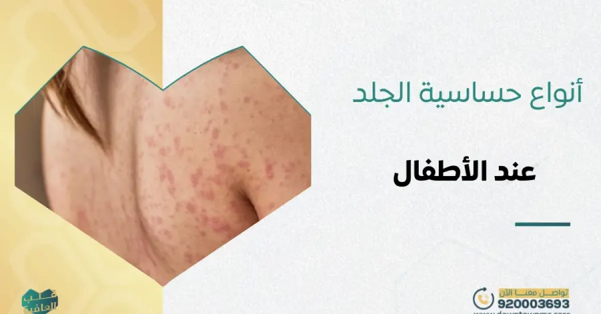 أنواع حساسية الجلد بالصور عند الأطفال​