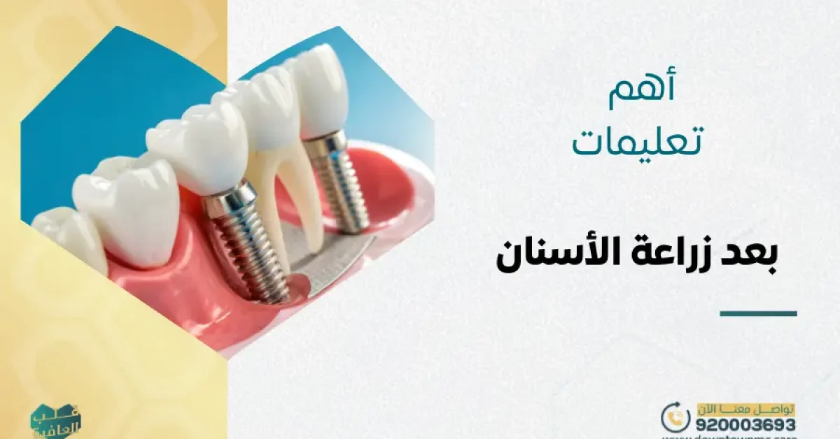 أهم تعليمات بعد زراعة الأسنان: دليل التعافي السريع