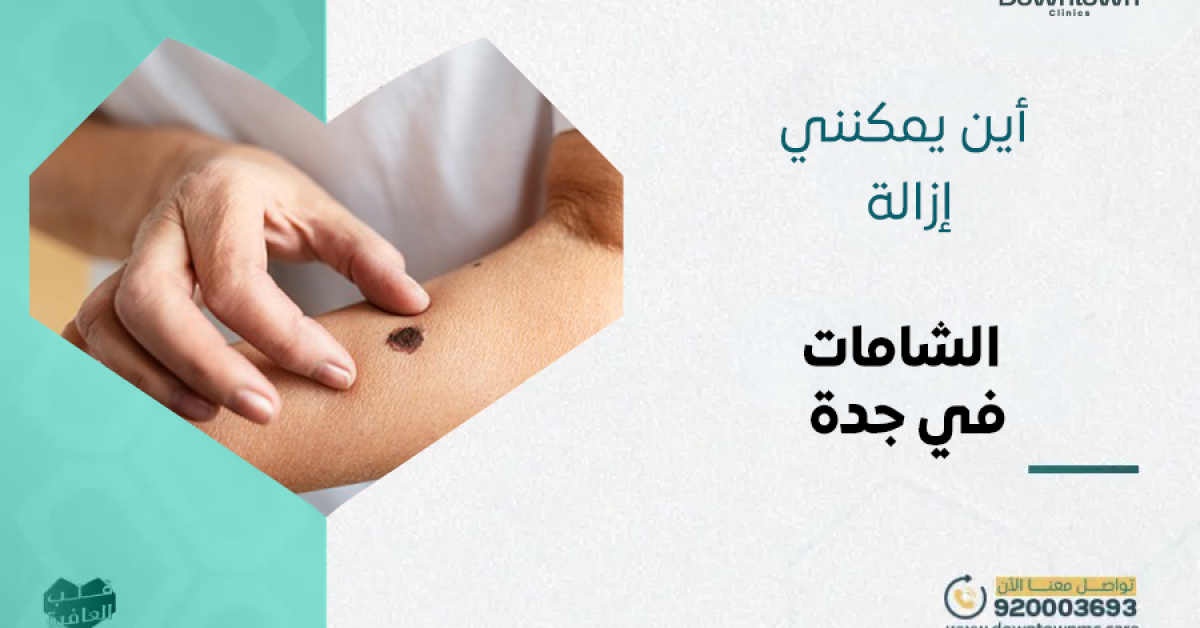 أين يمكنني إزالة الشامات في جدة؟