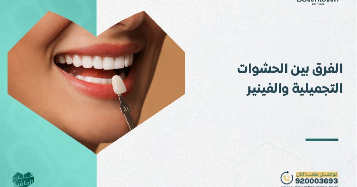 الفرق بين الحشوات التجميلية والفينير