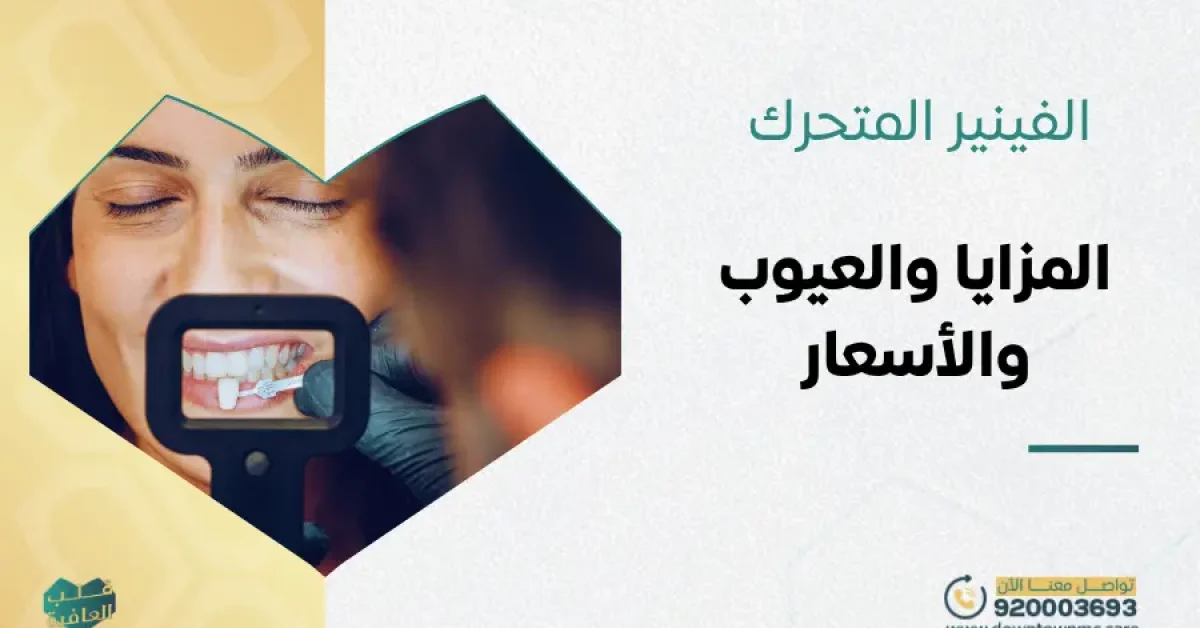الفينير المتحرك المزايا والعيوب والأسعار