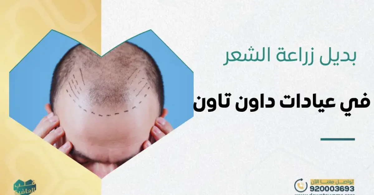 بديل زراعة الشعر في عيادات داون تاون