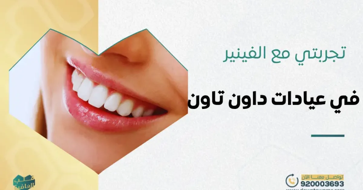 تجربتي مع الفينير في عيادات داون تاون