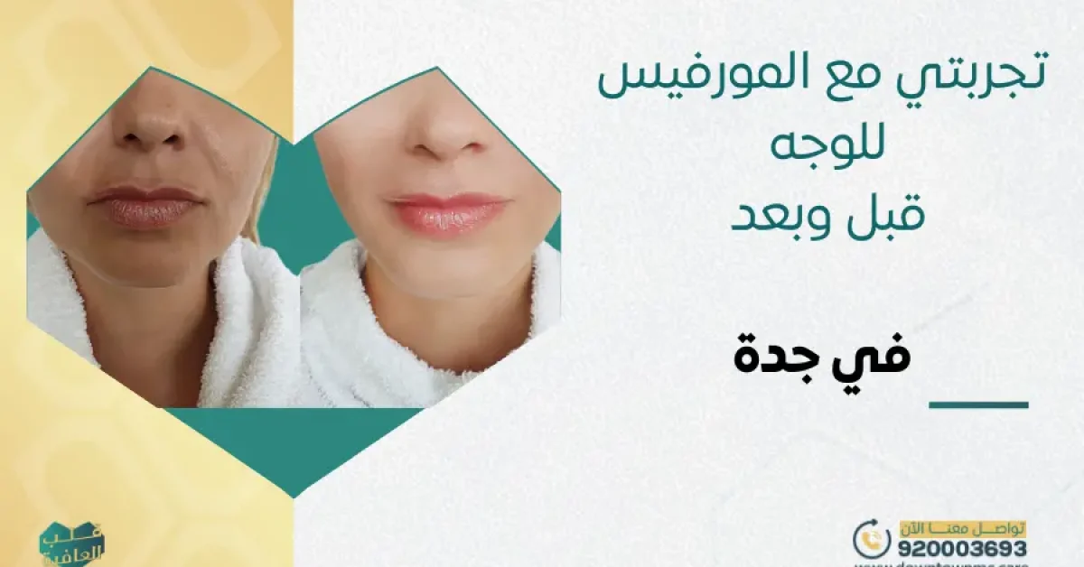 تجربتي مع المورفيس للوجه قبل وبعد في جدة