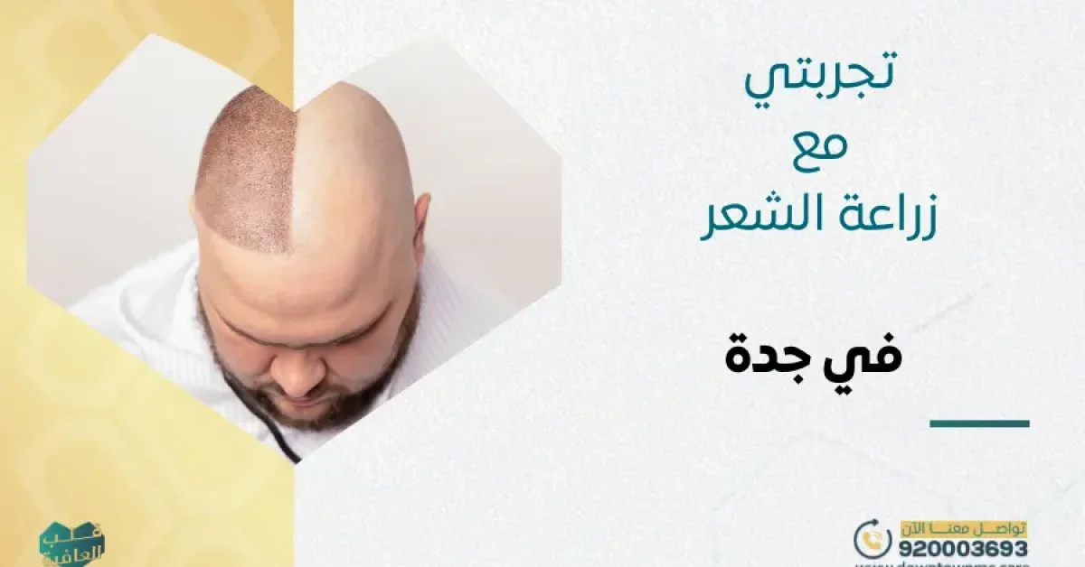 تجربتي مع زراعة الشعر في جدة