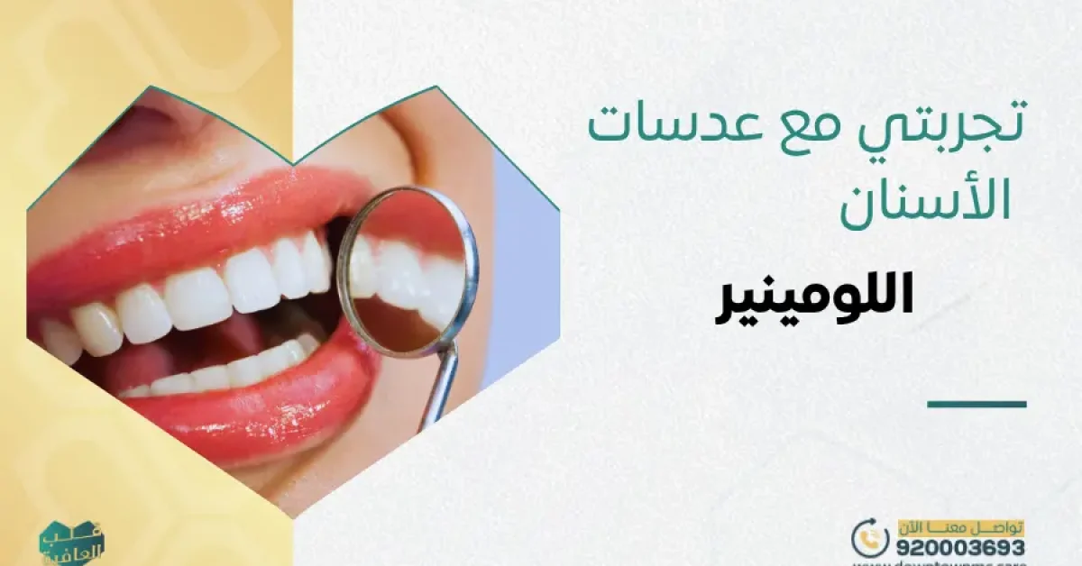 تجربتي مع عدسات الأسنان اللومينير