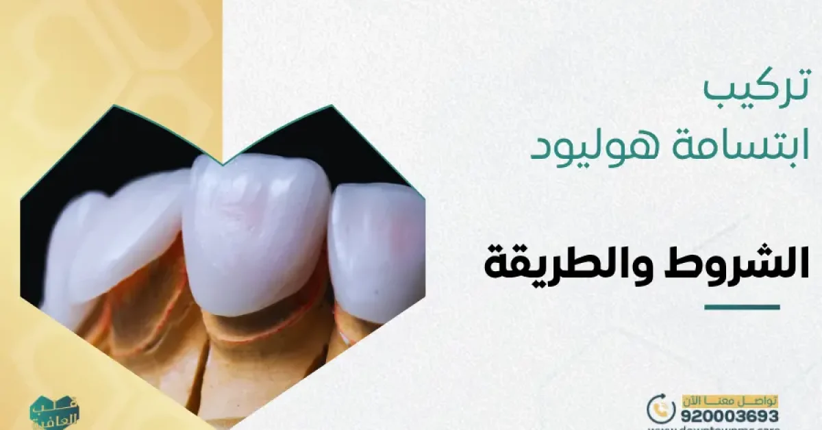 تركيب ابتسامة هوليود