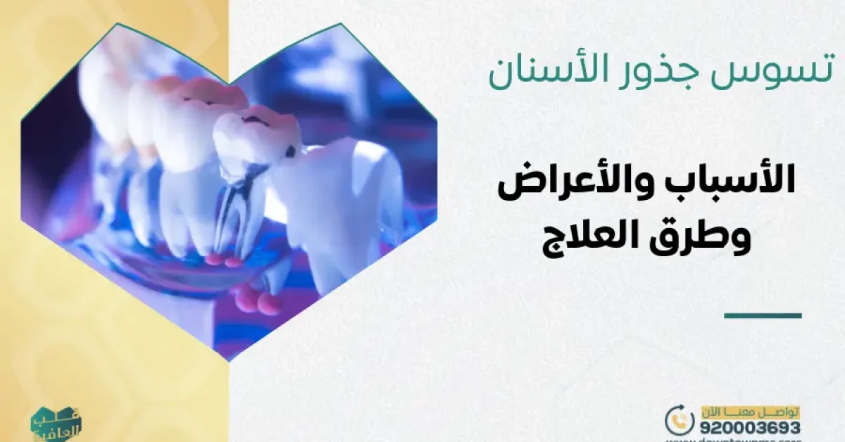 تسوس جذور الأسنان
