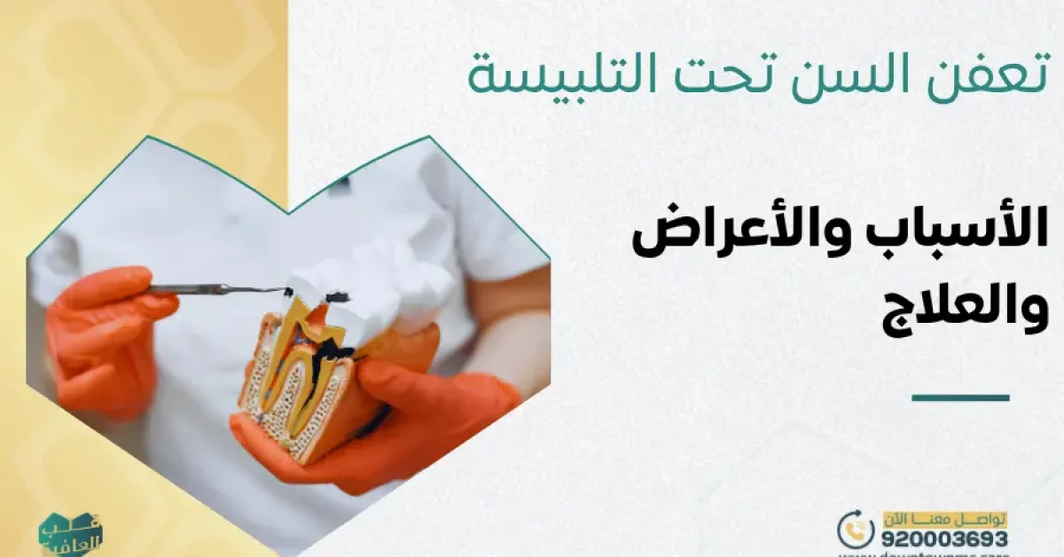 تعفن السن تحت التلبيسة: الأسباب والأعراض وطرق العلاج