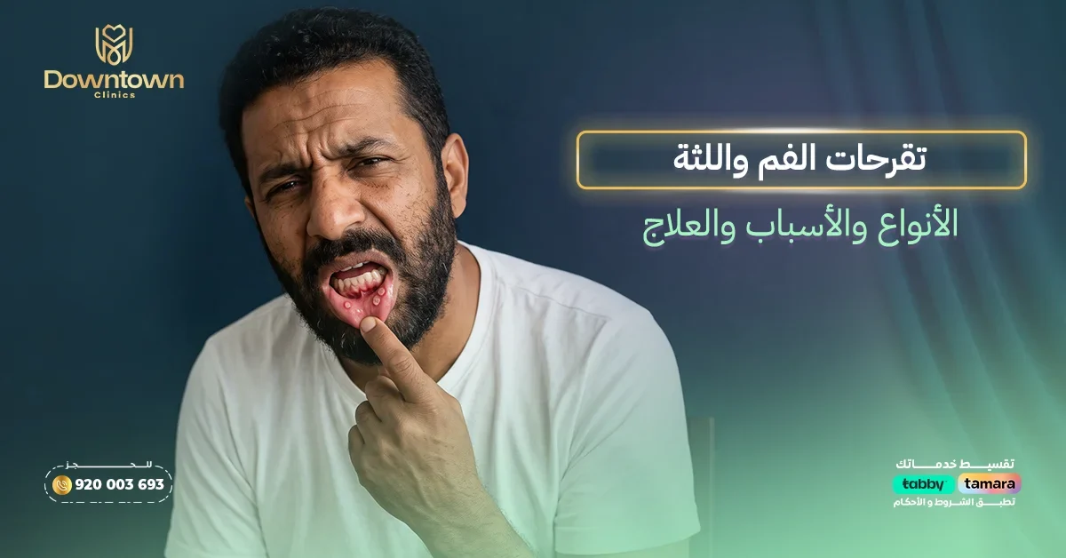 تقرحات الفم واللثة - الأنواع والأسباب والعلاج