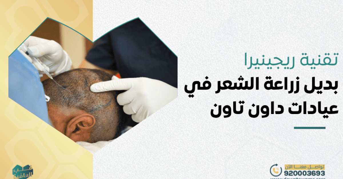 تقنية ريجينيرا بديل زراعة الشعر في عيادات داون تاون