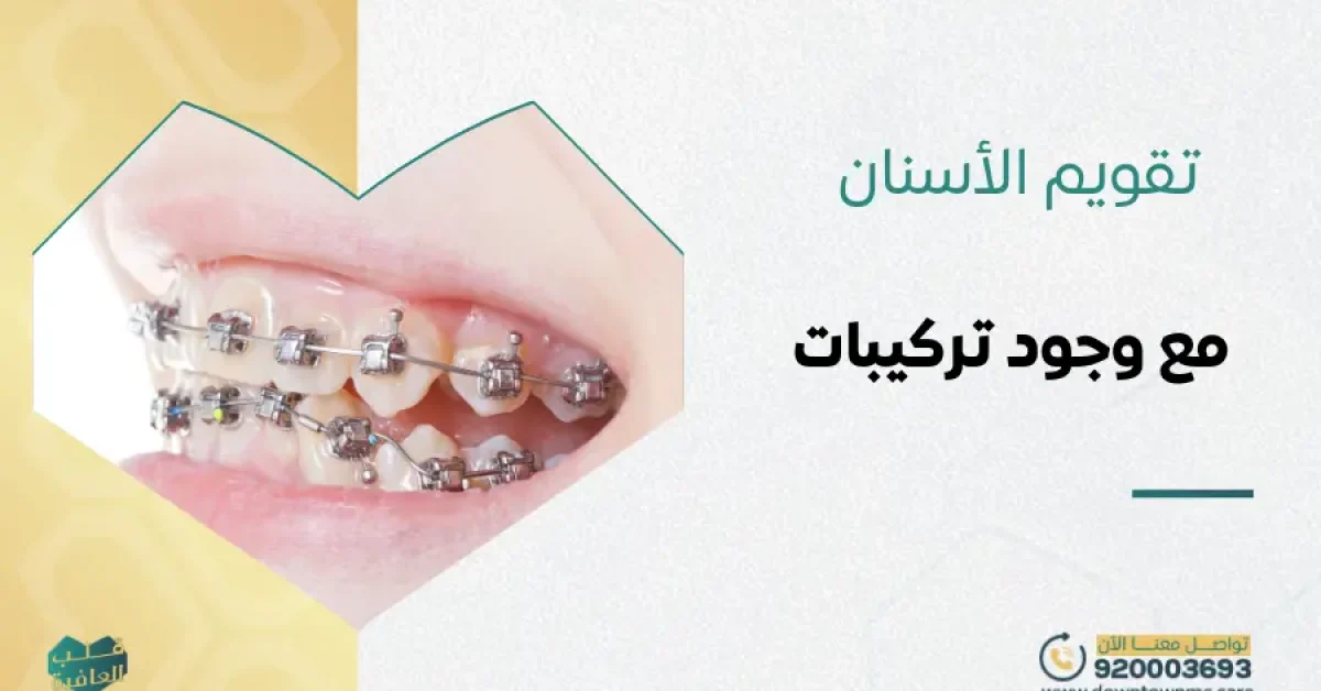 تقويم الأسنان مع وجود تركيبات