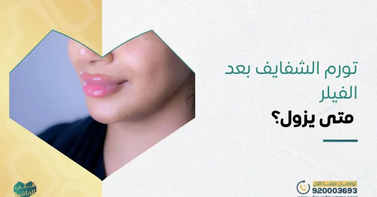 تورم الشفايف بعد الفيلر