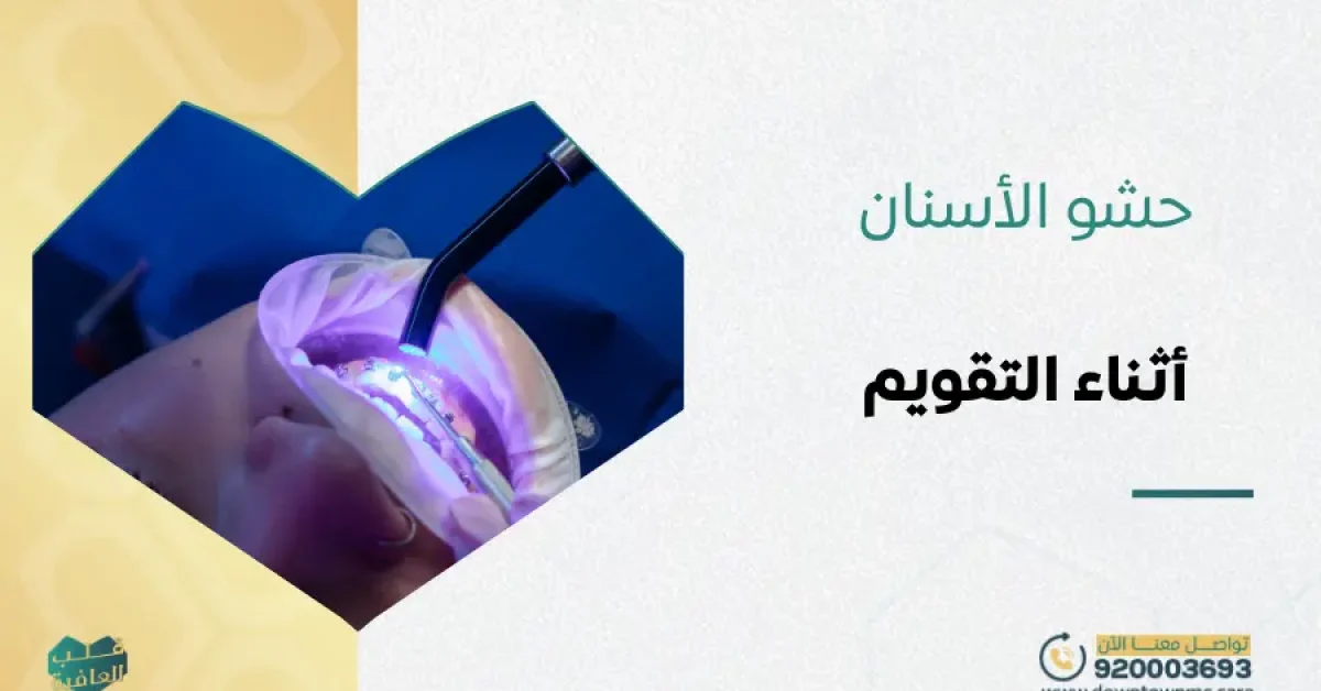 حشو الأسنان أثناء التقويم