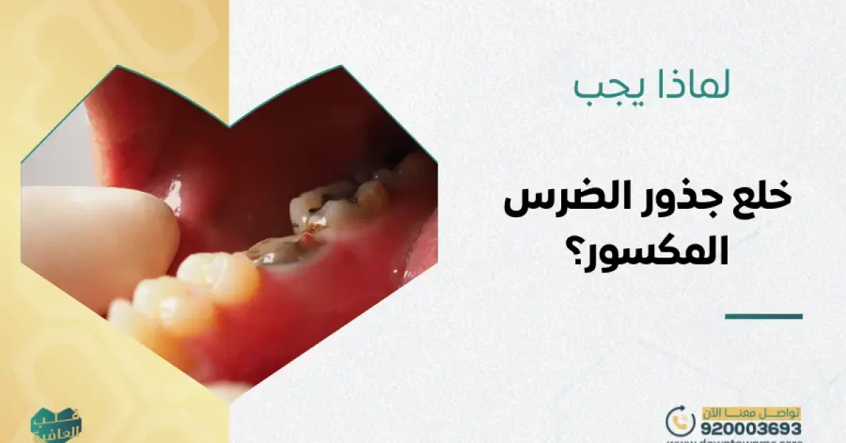 خلع جذور الضرس المكسور