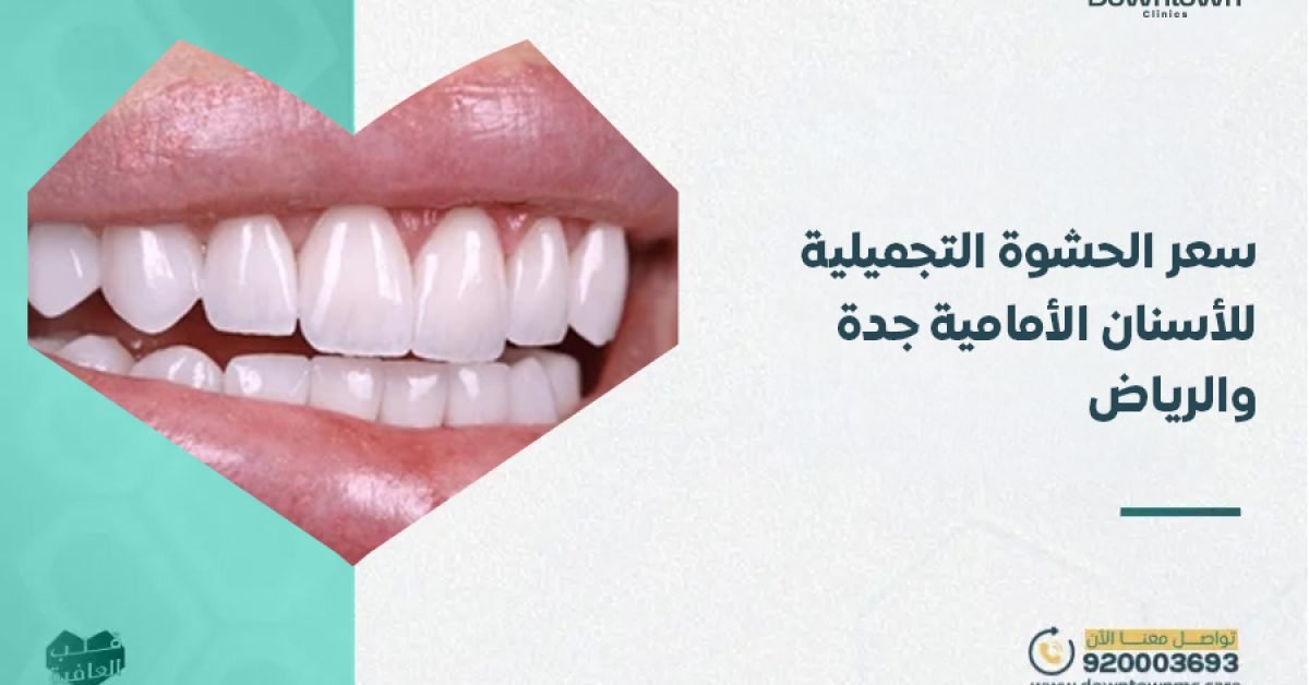 سعر الحشوة التجميلية للأسنان الأمامية جدة والرياض