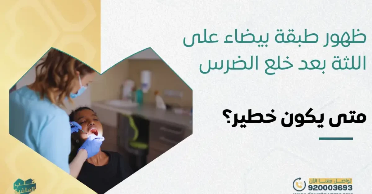 ظهور طبقة بيضاء على اللثة بعد خلع الضرس