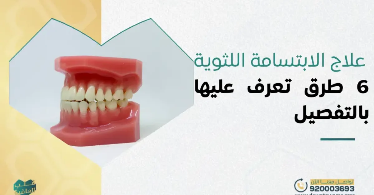 علاج الابتسامة اللثوية