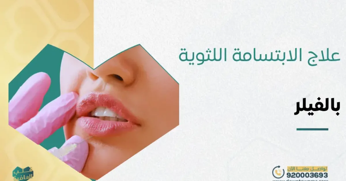 علاج الابتسامة اللثوية بالفيلر