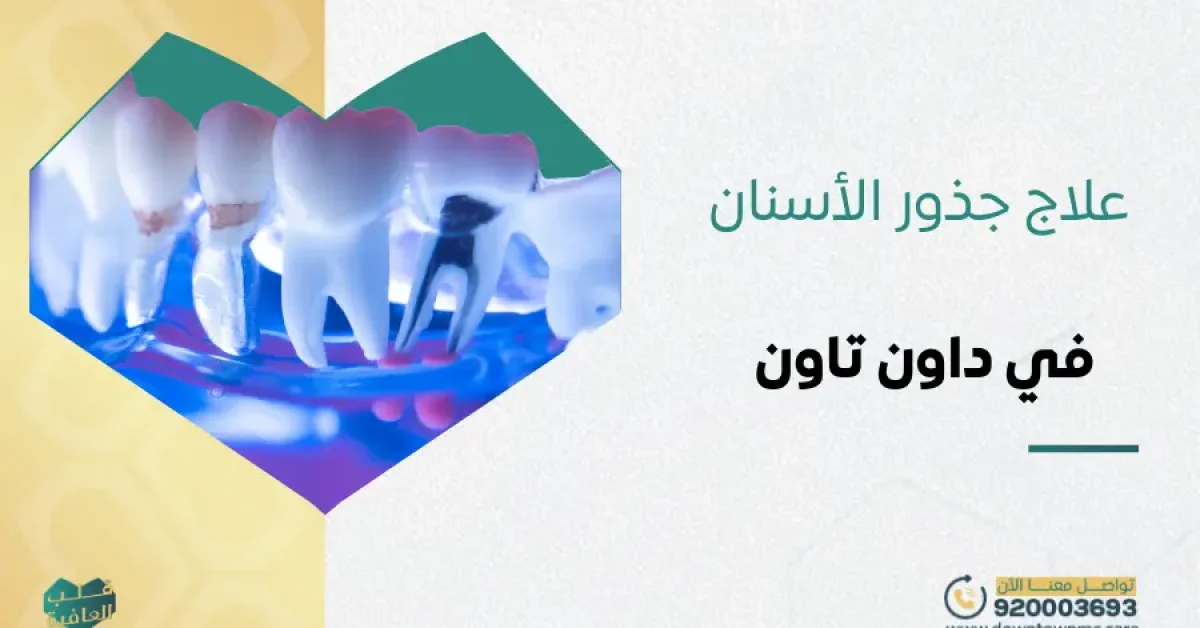 علاج جذور الأسنان بأحدث التقنيات