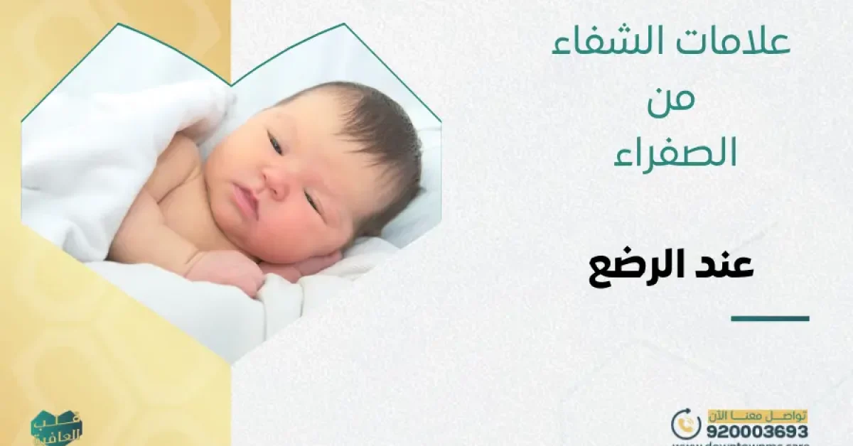 علامات الشفاء من الصفراء عند الرضع