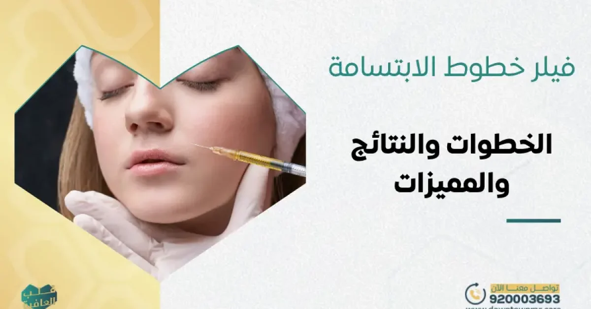 فيلر خطوط الابتسامة