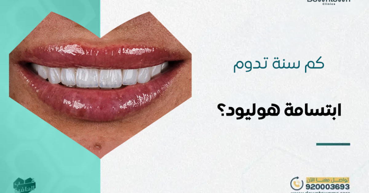 كم سنة تدوم ابتسامة هوليود